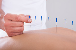Woman Receiving Acupuncture Therapy
